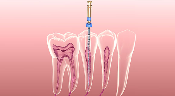 Endodontie/Wurzelkanalbehandlung